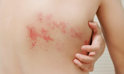 Zona görülme riski 50 yaşından sonra artıyor