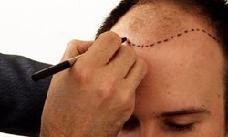 En İyi 10 Saç Ekimi Kliniği: Doğal Sonuçlar İçin Nereden Başlamalı?