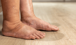 Diyabetik ayak uzuv kaybına yol açabiliyor