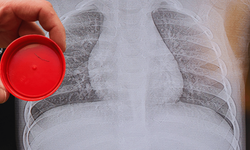 1 yaşındaki bebeğin sırtından metal tel çıkarıldı