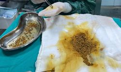 Bingöl’de hastanın safra kesesinden 2 bin 67 taş çıkarıldı