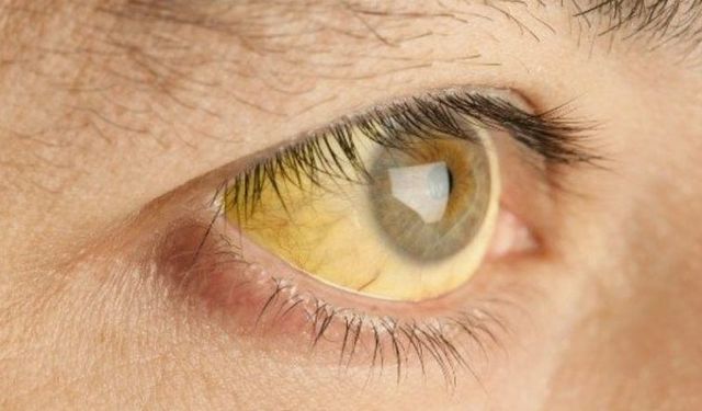 Fas, DSÖ tarafından Hepatit B’yi kontrol altına alan ülke ilan edildi