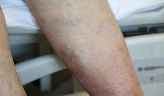 Varis oluşumu günlük yaşam alışkanlıklarıyla da yakından ilişkili