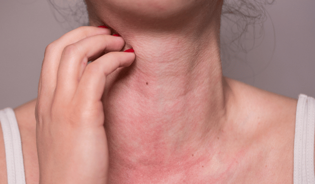 Alerjide en önemli faktörlerden biri genetik yatkınlık