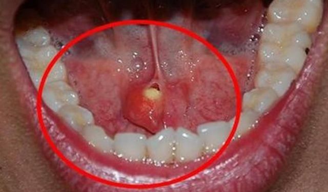 Tükürük bezi taşı tedavi edilmezse hayati tehlikeye yol açabilir