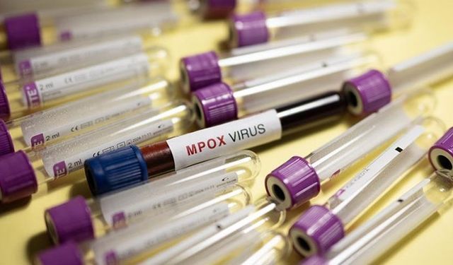 Gana'da bir haftada 19 yeni M çiçeği vakası görüldü