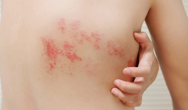 Zona görülme riski 50 yaşından sonra artıyor