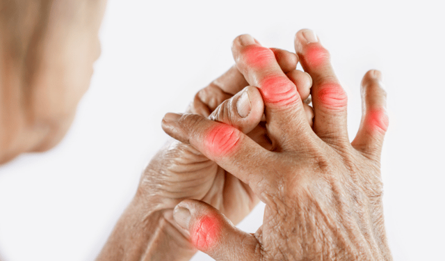 Psöriatik artritte erken tanı önem taşıyor