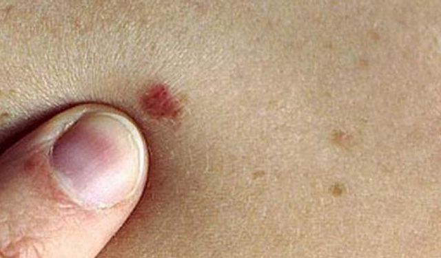 Ciltte beliren kırmızı benlere dikkat