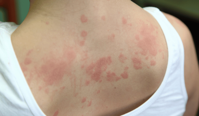 Çocuklarda kronik ürtiker uyku ve yaşam kalitesini düşürüyor