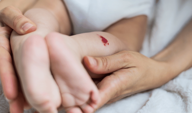 Çocuklarda bazı ben türleri düzenli takip gerektiriyor