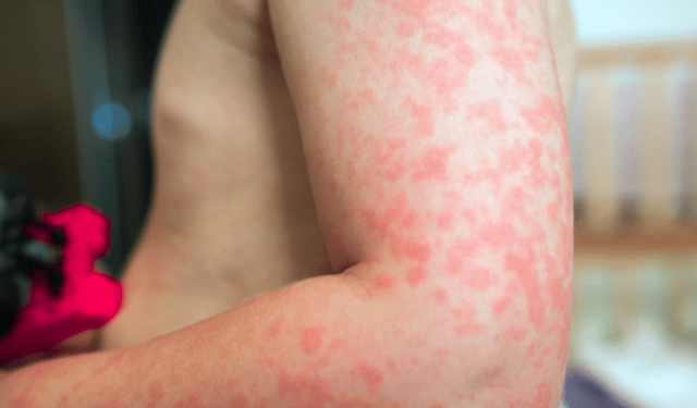 Araştırmaya göre, her 20 çocuktan birinde 6 yaşına kadar gıda alerjisi görülebilir