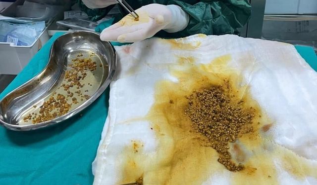 Bingöl’de hastanın safra kesesinden 2 bin 67 taş çıkarıldı