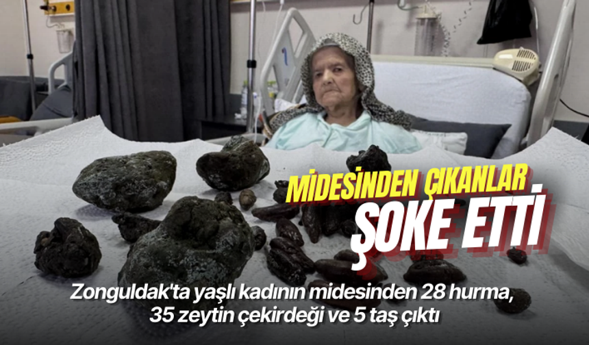 Zonguldak'ta yaşlı kadının midesinden 28 hurma, 35 zeytin çekirdeği ve 5 taş çıktı