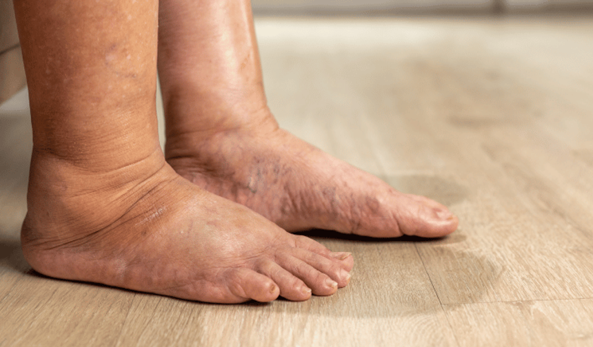 Diyabetik ayak uzuv kaybına yol açabiliyor