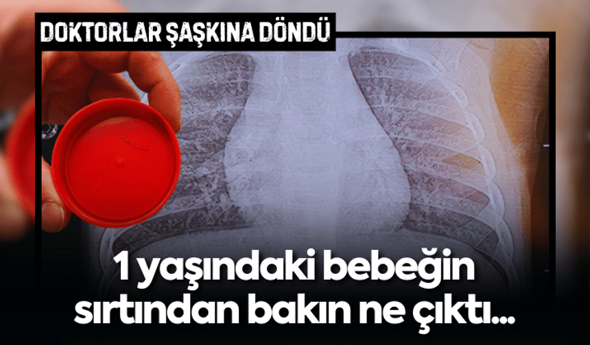 1 yaşındaki bebeğin sırtından metal tel çıkarıldı