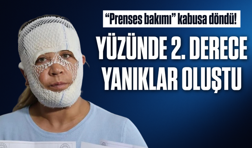 “Prenses bakımı” kabusa döndü! Yüzünde 2. derece yanıklar oluştu