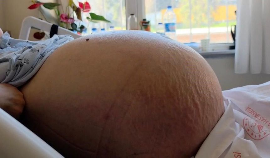 İstanbul’da şoke eden olay! Karnından 22 kiloluk tümör çıktı