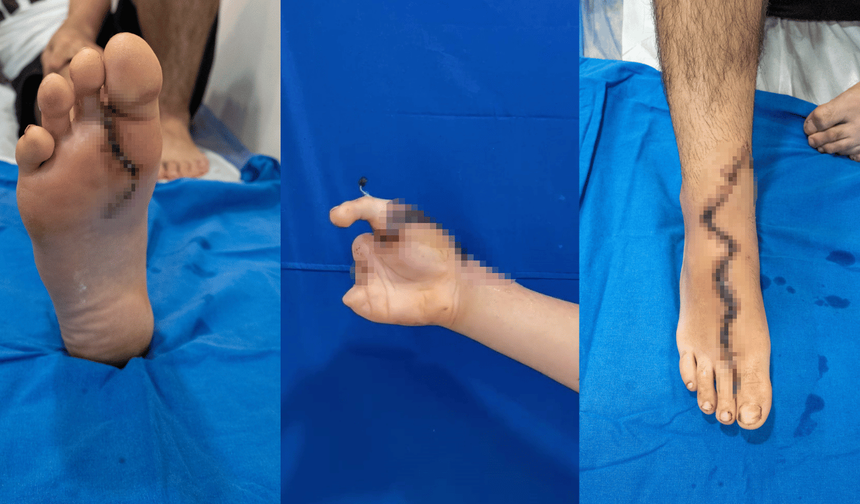 13 yaşındaki çocuk 5 parmağını kıyma makinesine kaptırdı! Ayağından eline parmak nakledildi