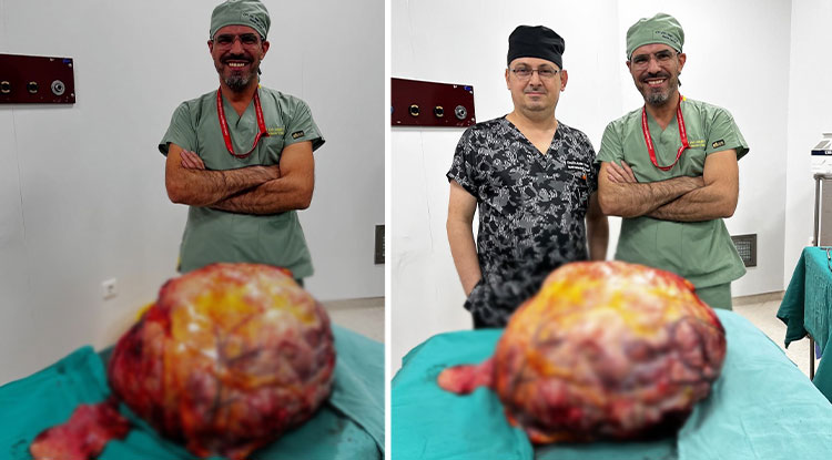 Karnından 26 Kilogramlık Tümör Çıktı