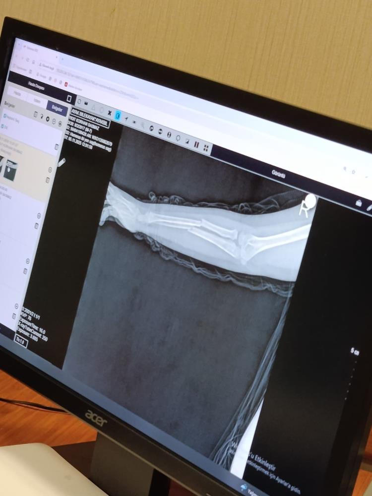 Arkadaşının Kolunu Kırdı