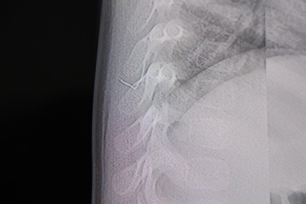 1 Yaşındaki Bebeğin Sırtından Metal Tel Çıkarıldı