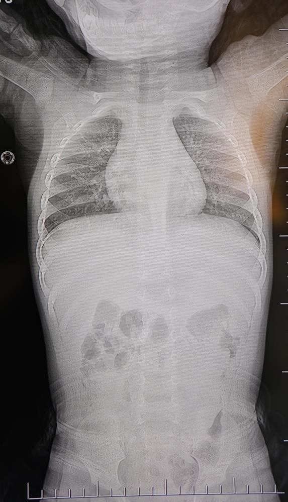 1 Yaşındaki Bebeğin Sırtından Metal Tel Çıkarıldı1