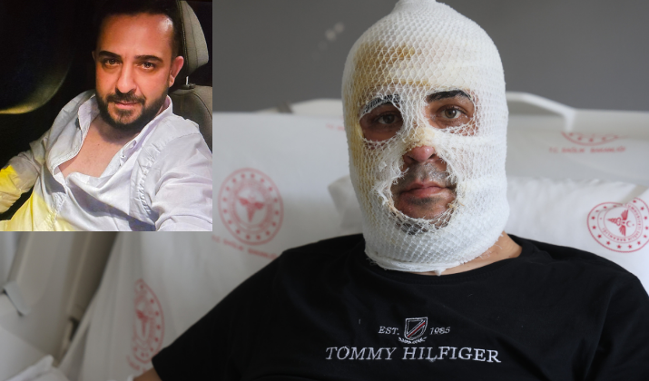 Depremden Sonra Kurduğu Iş Yeri Kül Oldu Yüzü Ve Vücudu Patlamada Yandı! (1)