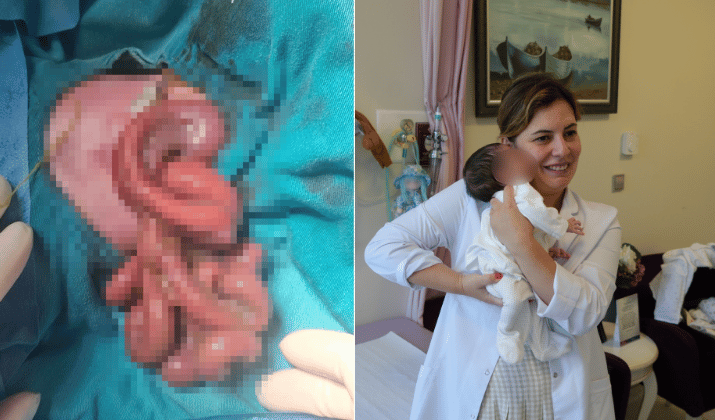 Organları Dışarıda Doğan Bebek, Samsun'da Hayata Tutundu-1